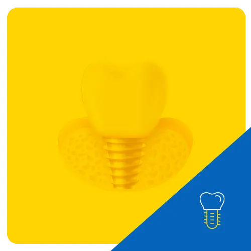 Dental Implants