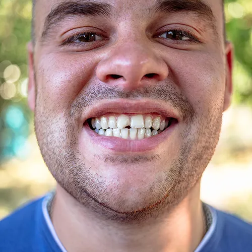 man smiling with chipped tooth