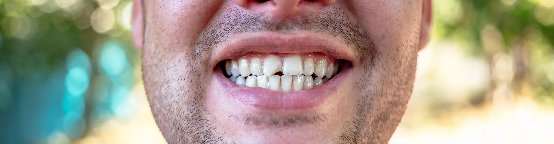 man smiling with chipped tooth