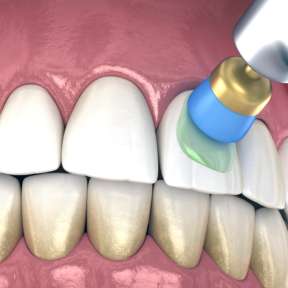 3D visualization of a dental polishing procedure on lower front teeth, emphasizing the precision and effectiveness of dental cleaning.