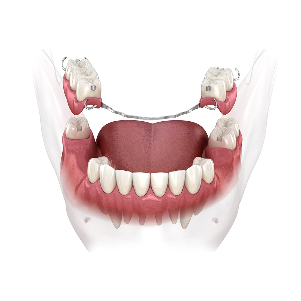 3D rendering of a partial denture for the lower jaw, showing how it fits around the remaining natural teeth with metal clasps for secure support.