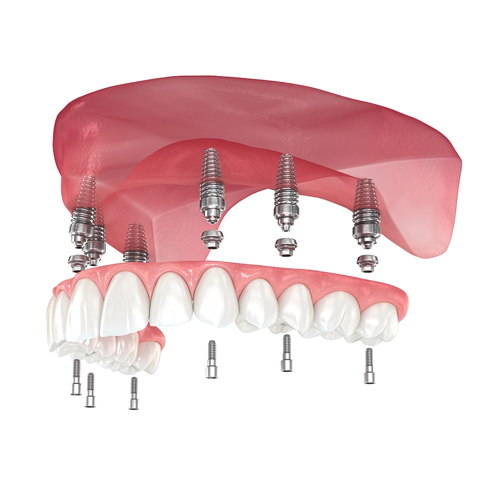 3D rendering of an implant-supported denture system, showing dental implants securely anchoring an upper denture in place, highlighting stability and support.